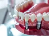 How to Choose the Best Dental Implant Specialist Anywhere in the World dental implants